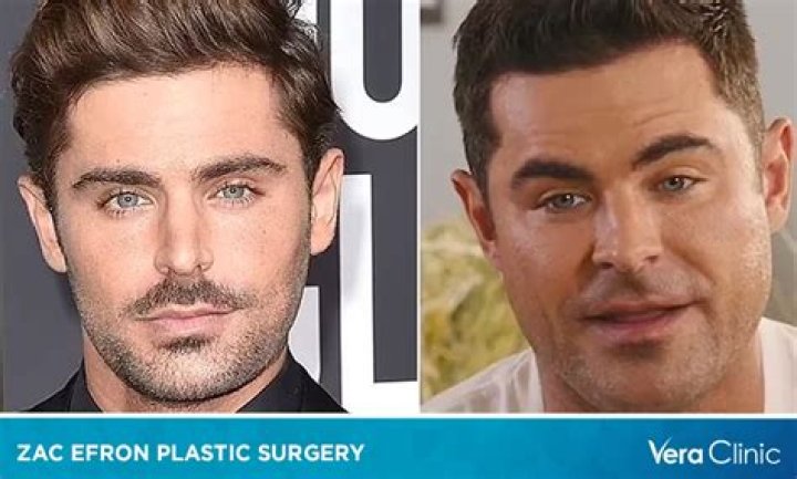Zac Efron: The Transformation Through Plastic Surgeries
